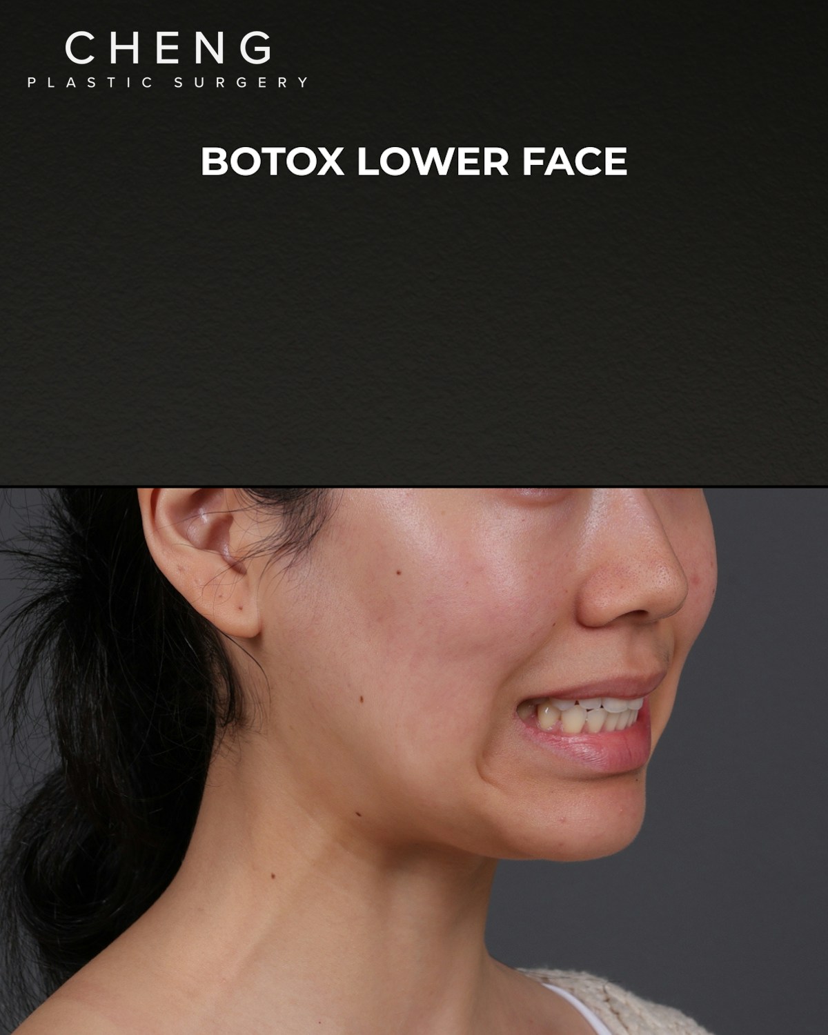 Botox and Dysport Before & After Gallery - Patient 326035 - Image 3