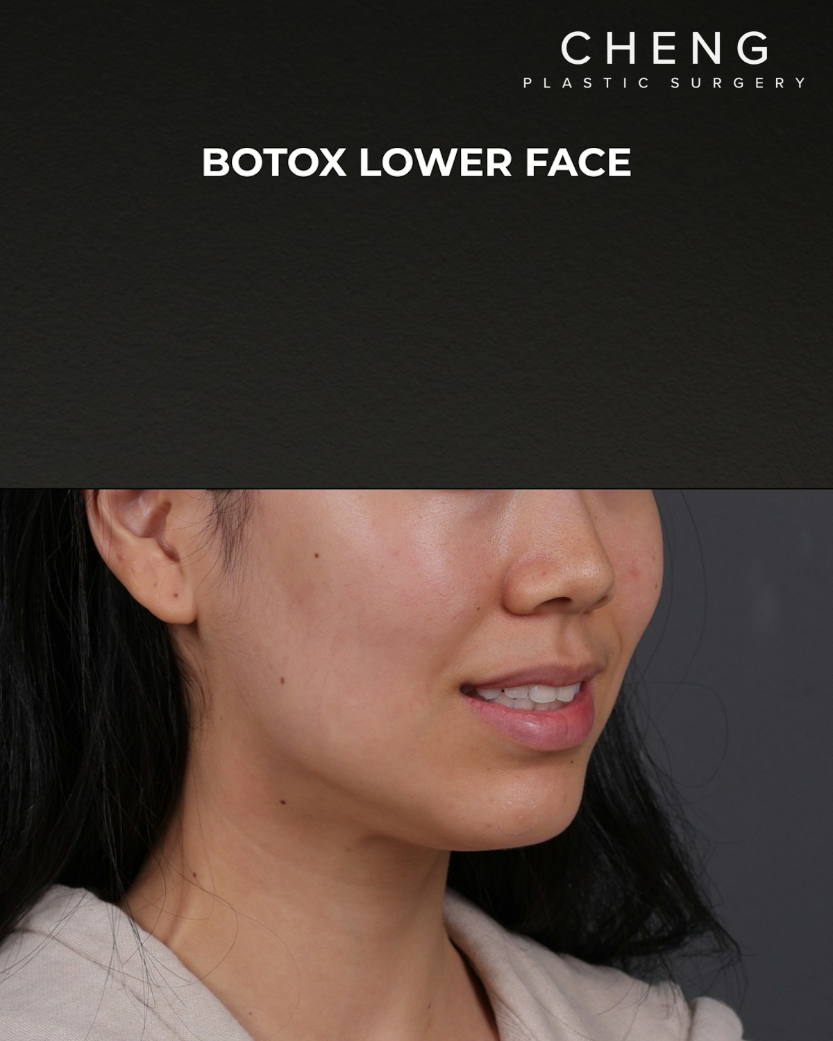Botox and Dysport Before & After Gallery - Patient 326035 - Image 4