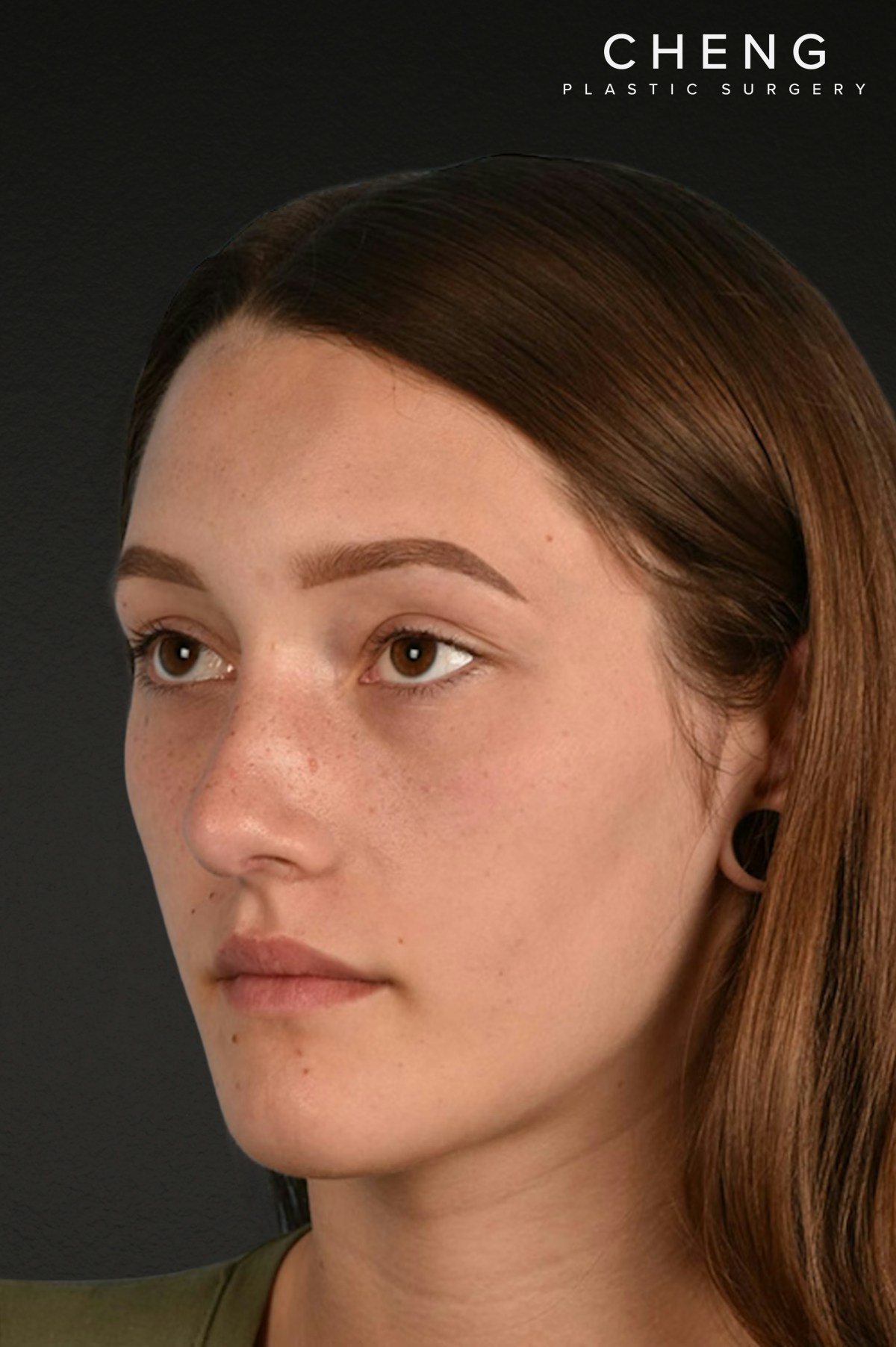 Rhinoplasty Before & After Gallery - Patient 399845 - Image 8