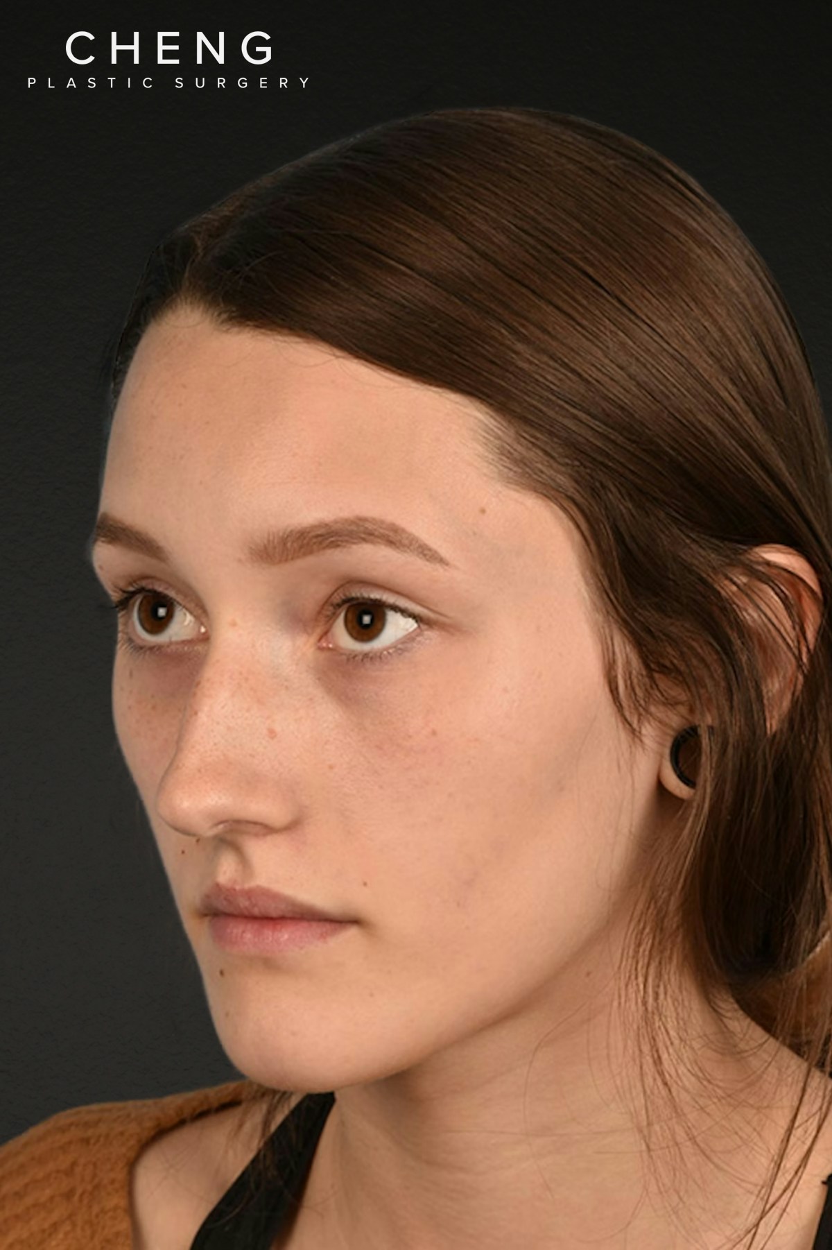Rhinoplasty Before & After Gallery - Patient 399845 - Image 7