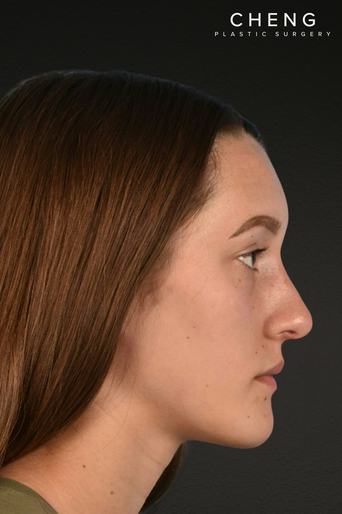 Rhinoplasty Before & After Gallery - Patient 399845 - Image 2