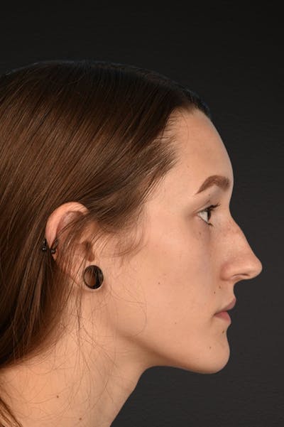 Rhinoplasty Before & After Gallery - Patient 399845 - Image 1