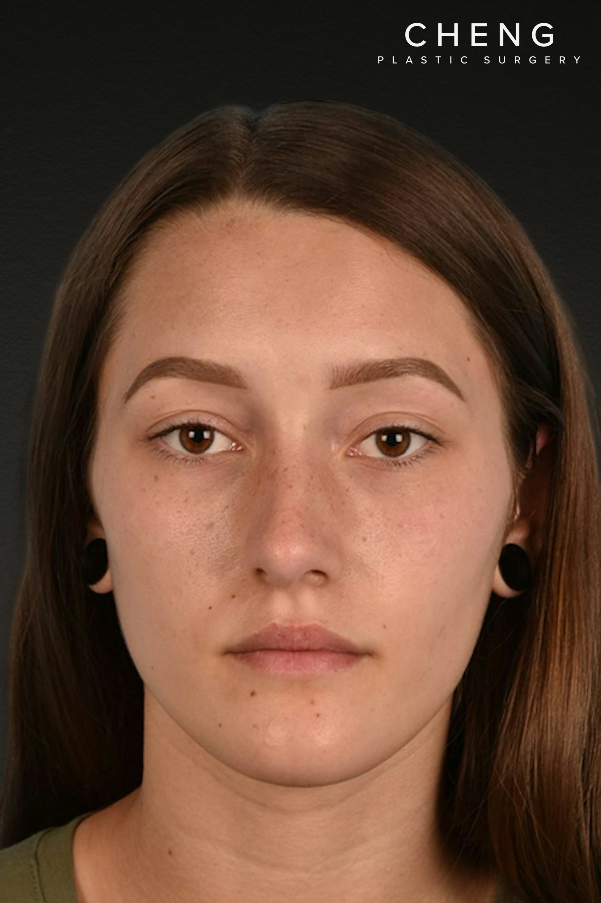 Rhinoplasty Before & After Gallery - Patient 399845 - Image 6