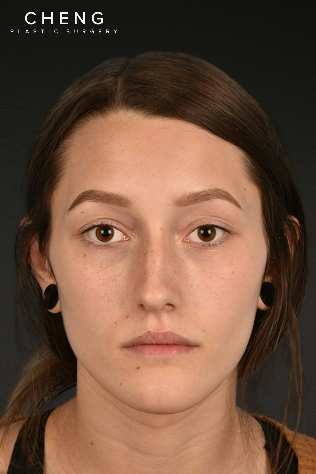 Rhinoplasty Before & After Gallery - Patient 399845 - Image 5