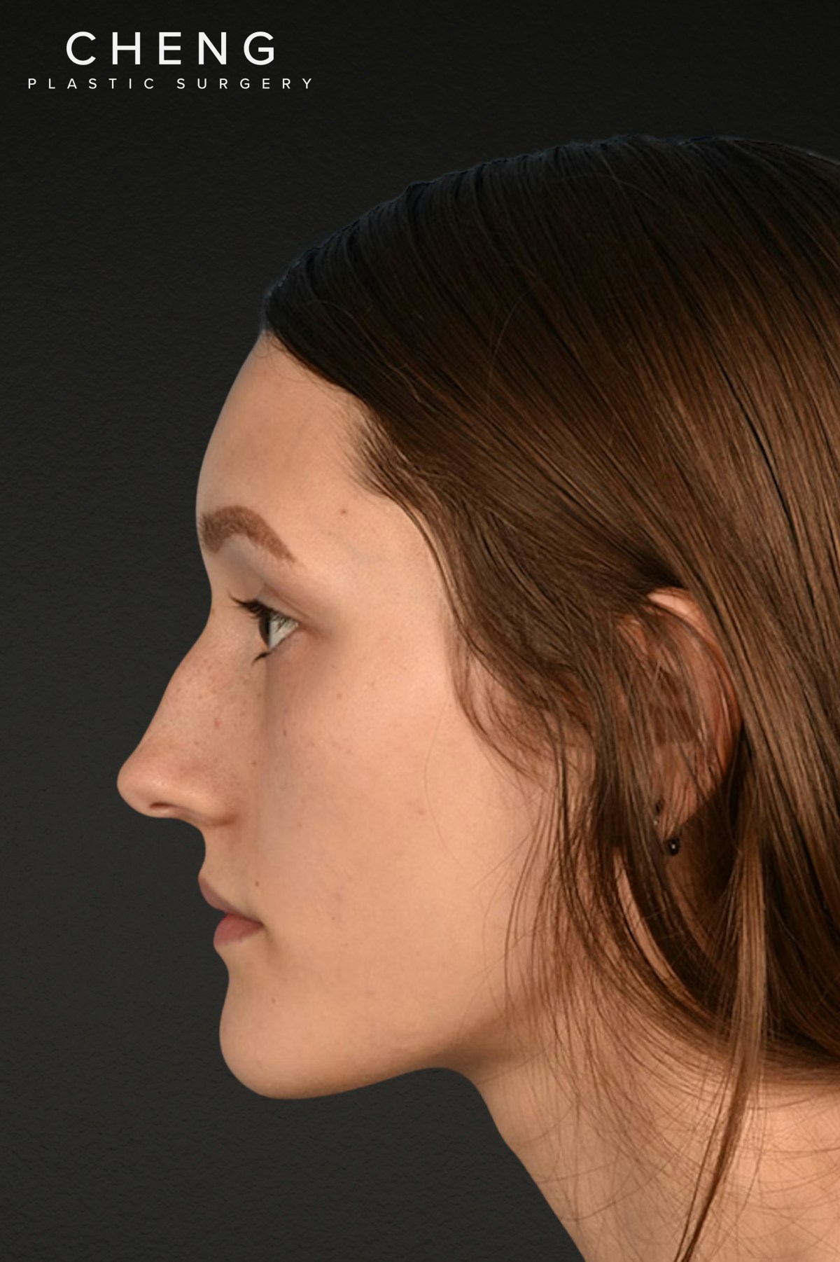 Rhinoplasty Before & After Gallery - Patient 399845 - Image 9