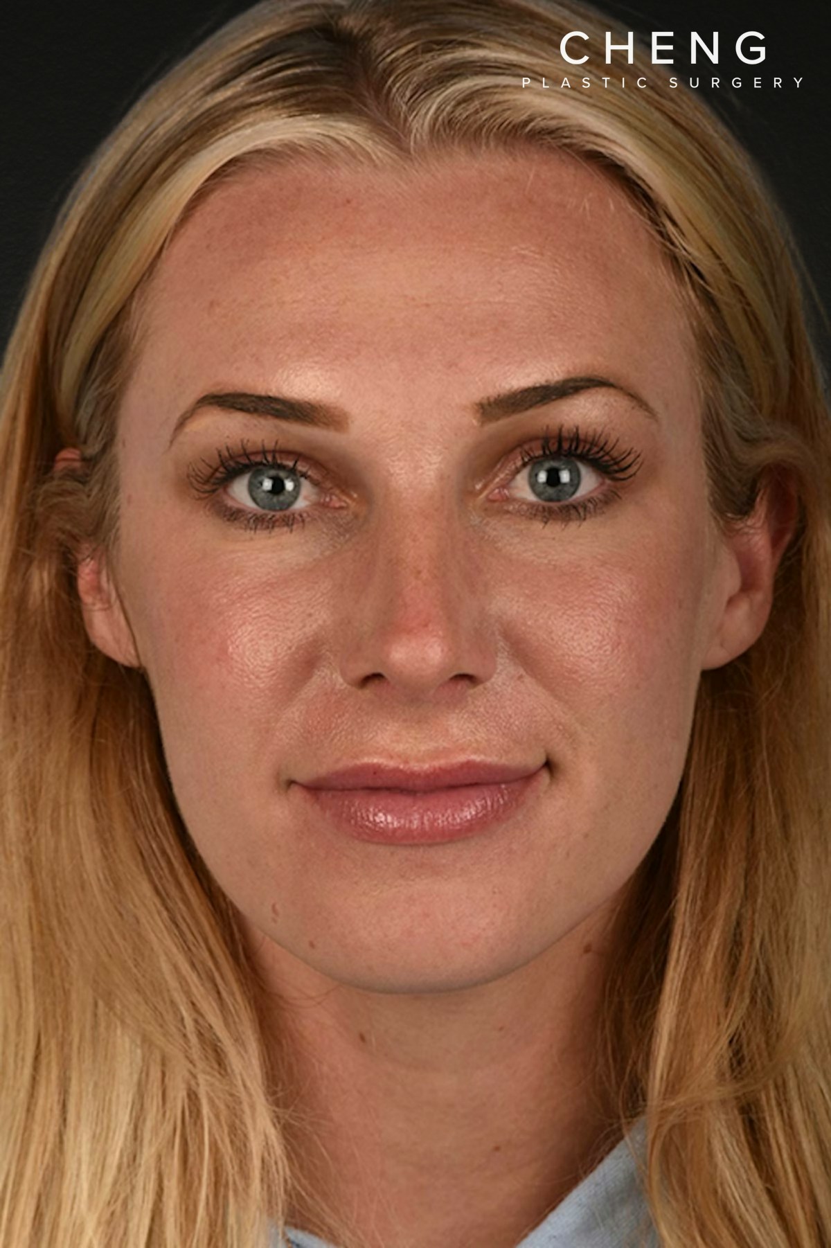 Rhinoplasty Before & After Gallery - Patient 791300 - Image 6