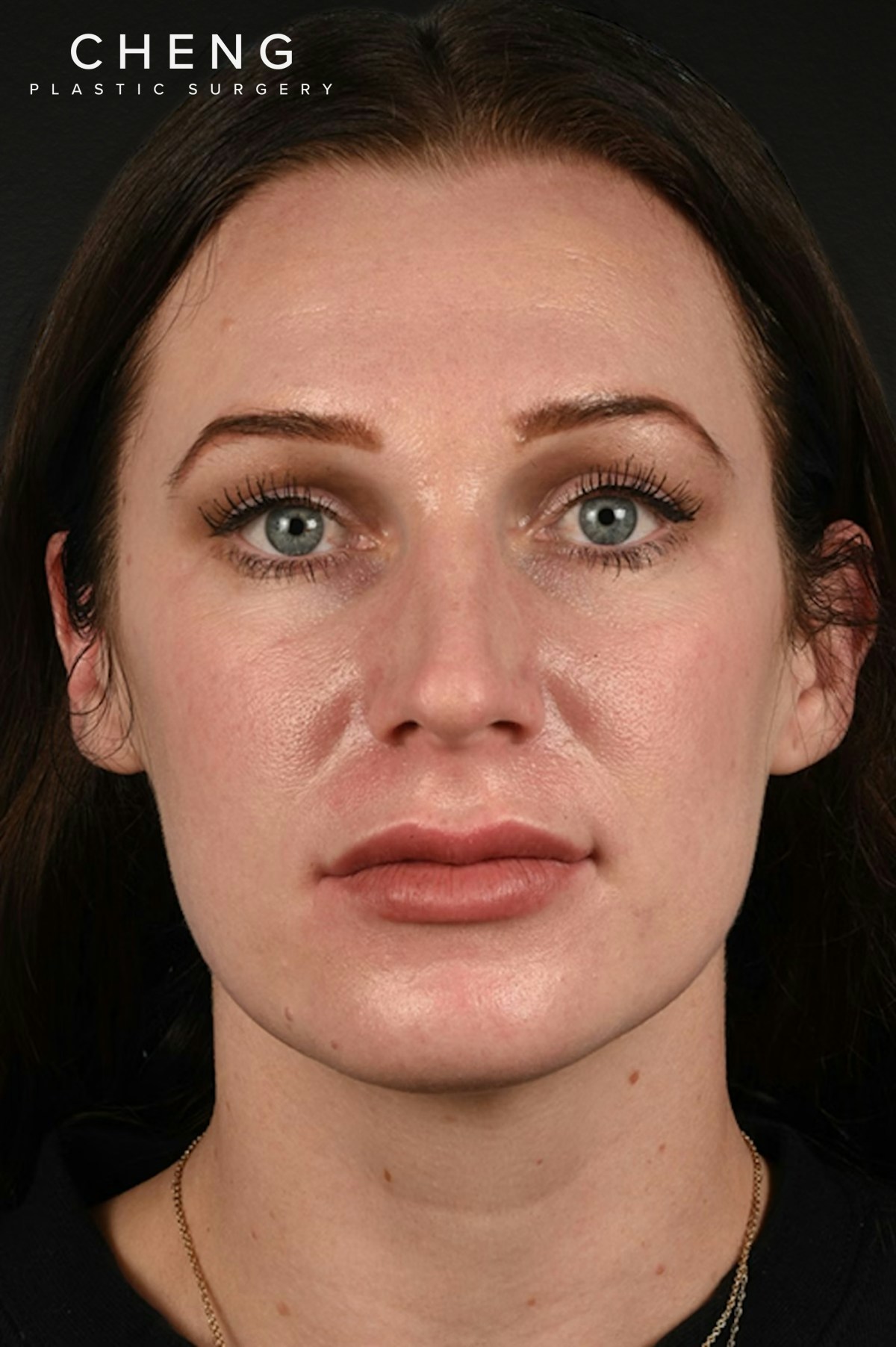 Rhinoplasty Before & After Gallery - Patient 791300 - Image 5
