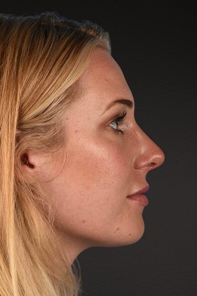 Rhinoplasty Before & After Gallery - Patient 791300 - Image 2