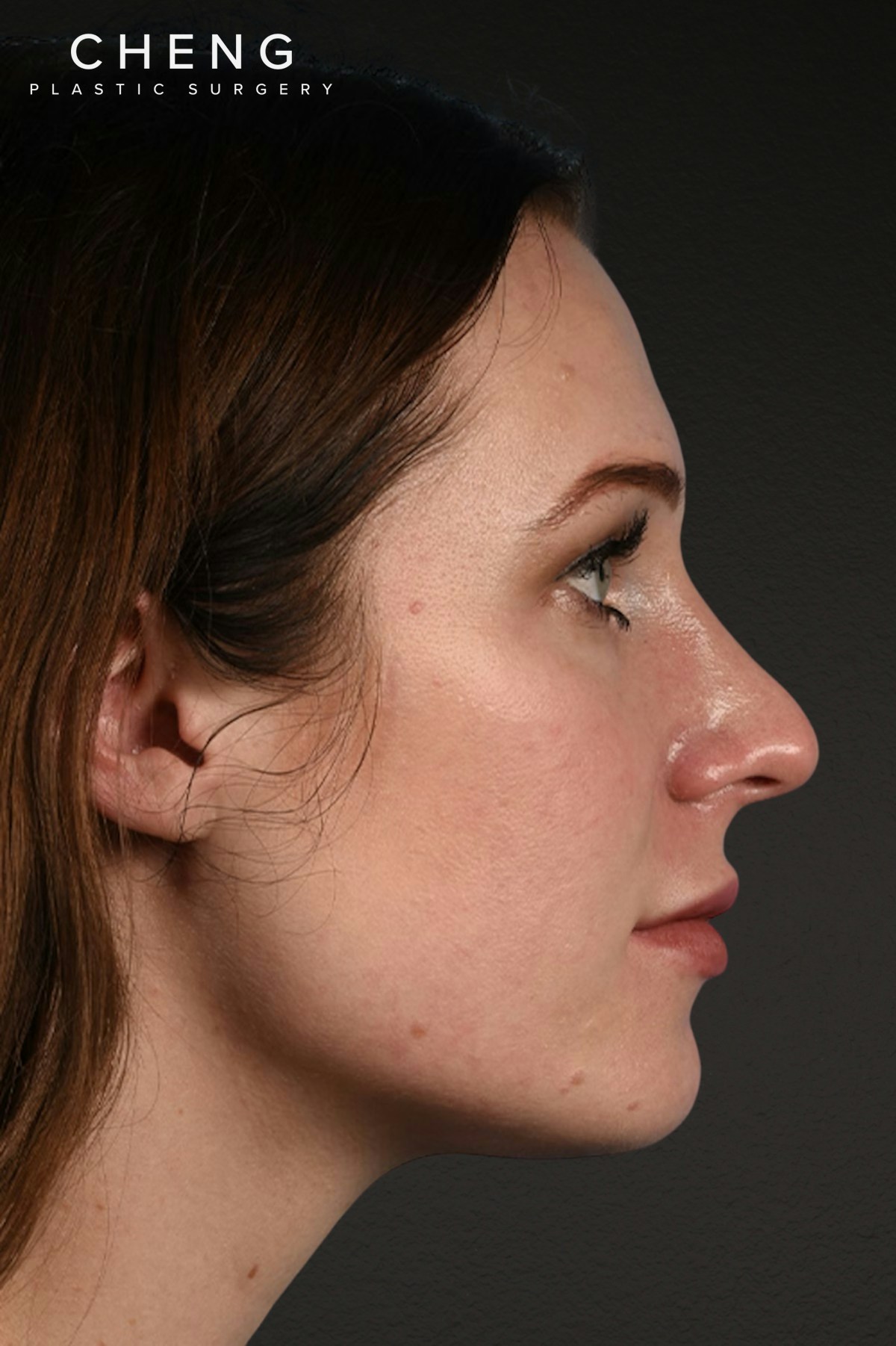 Rhinoplasty Before & After Gallery - Patient 791300 - Image 1