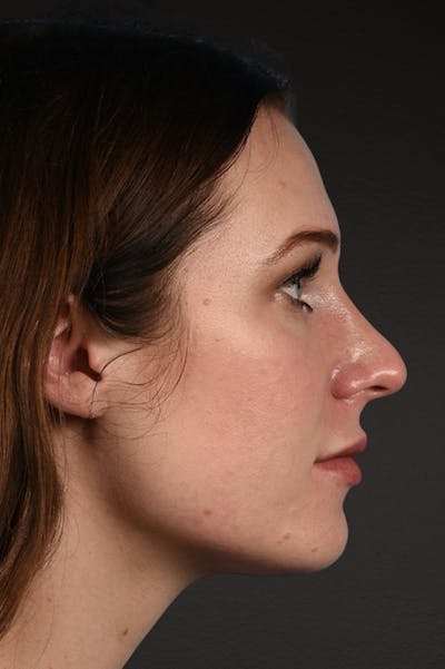 Rhinoplasty Before & After Gallery - Patient 791300 - Image 1