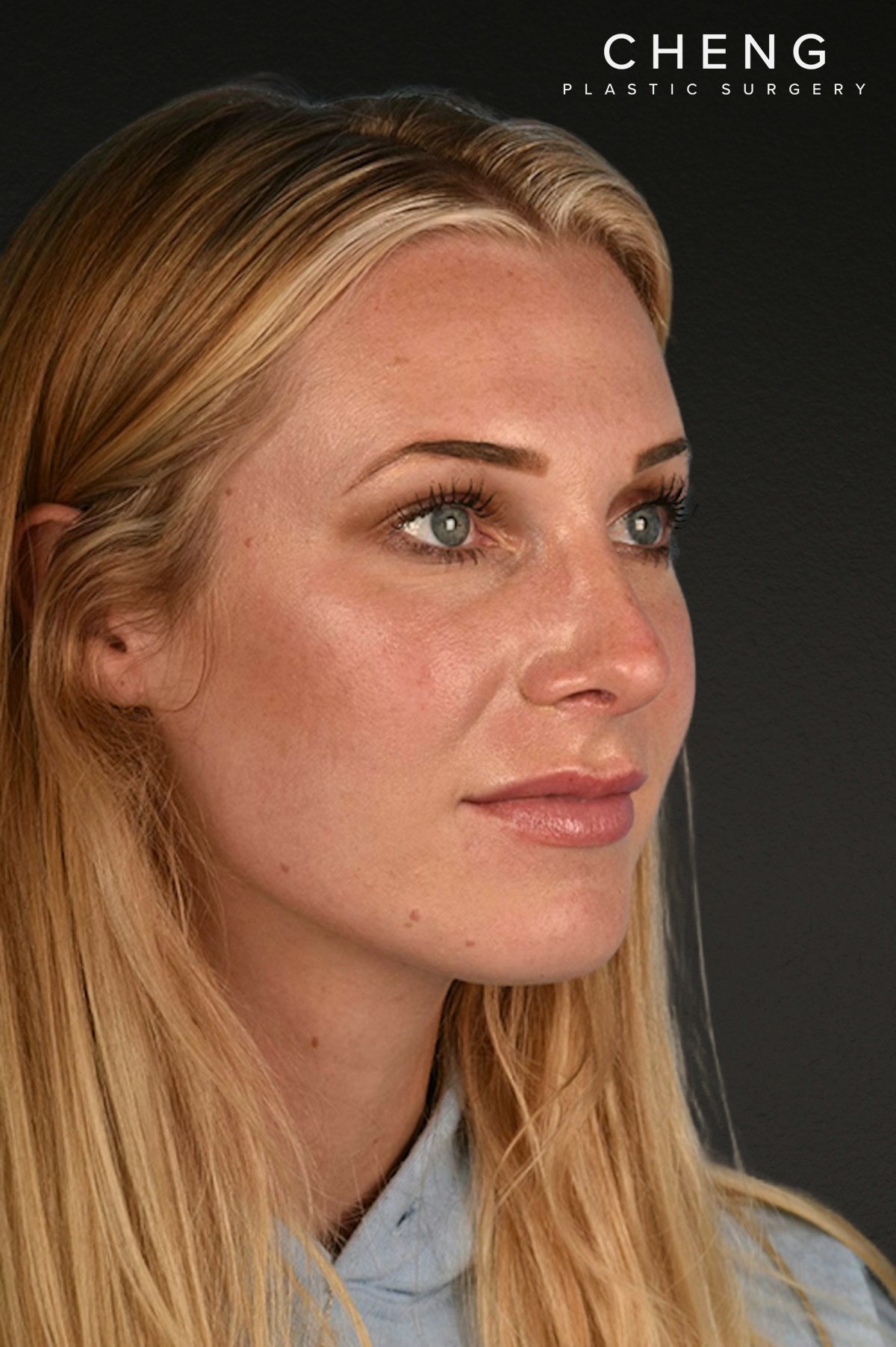 Rhinoplasty Before & After Gallery - Patient 791300 - Image 4