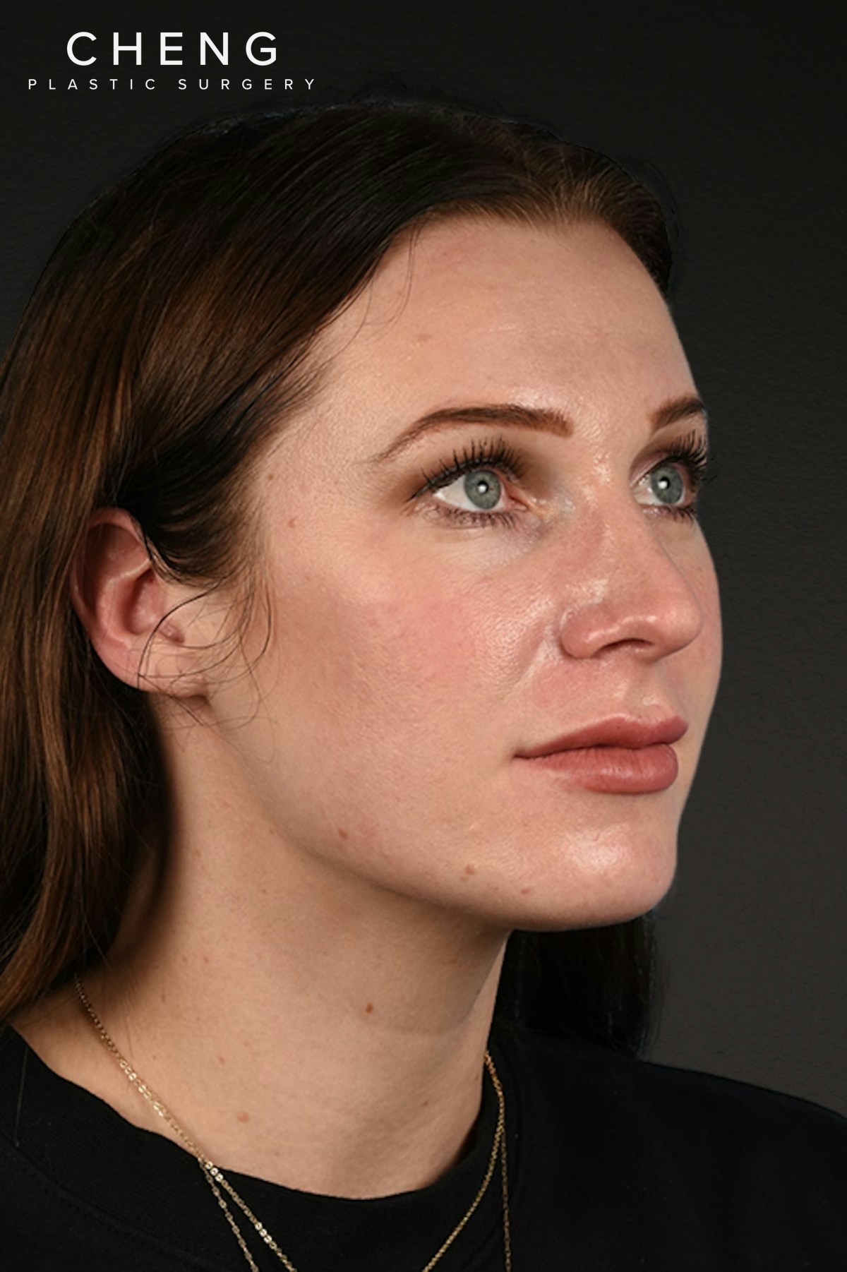 Rhinoplasty Before & After Gallery - Patient 791300 - Image 3