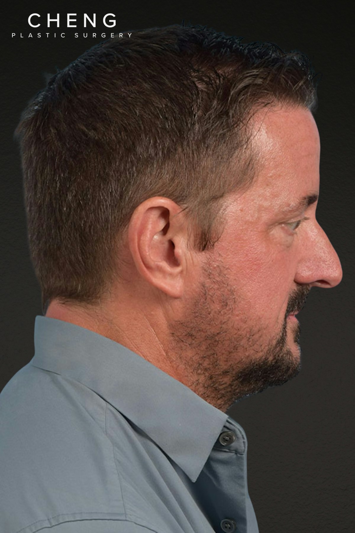 Rhinoplasty Before & After Gallery - Patient 381623 - Image 1