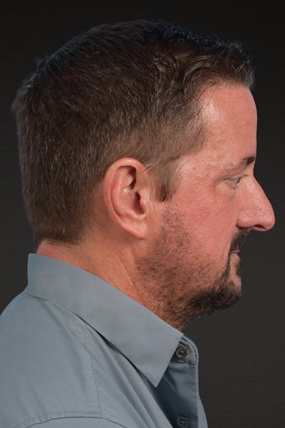 Rhinoplasty Before & After Gallery - Patient 381623 - Image 1