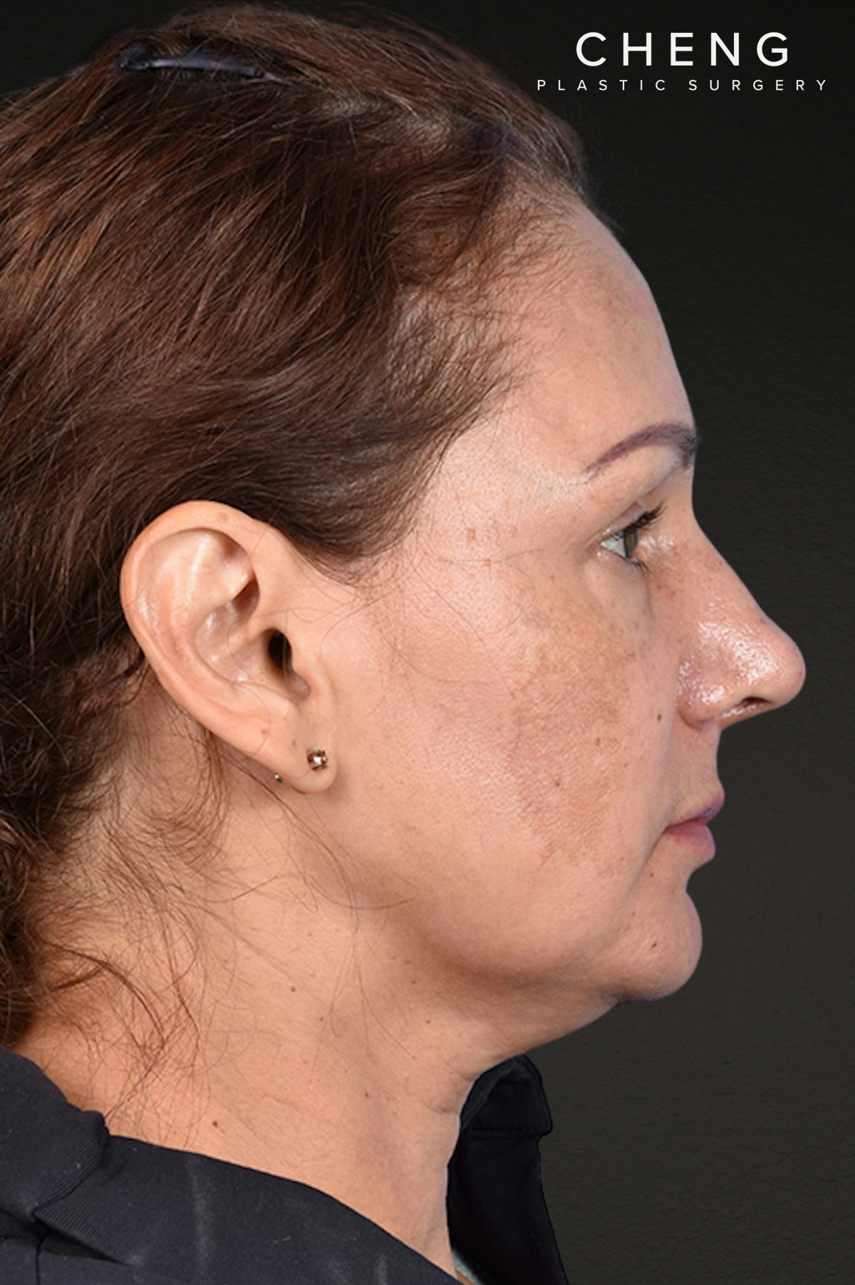 Rhinoplasty Before & After Gallery - Patient 178828 - Image 2