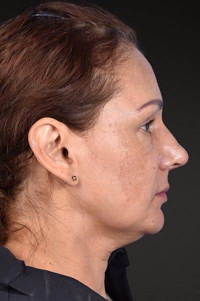 Rhinoplasty Before & After Gallery - Patient 178828 - Image 2