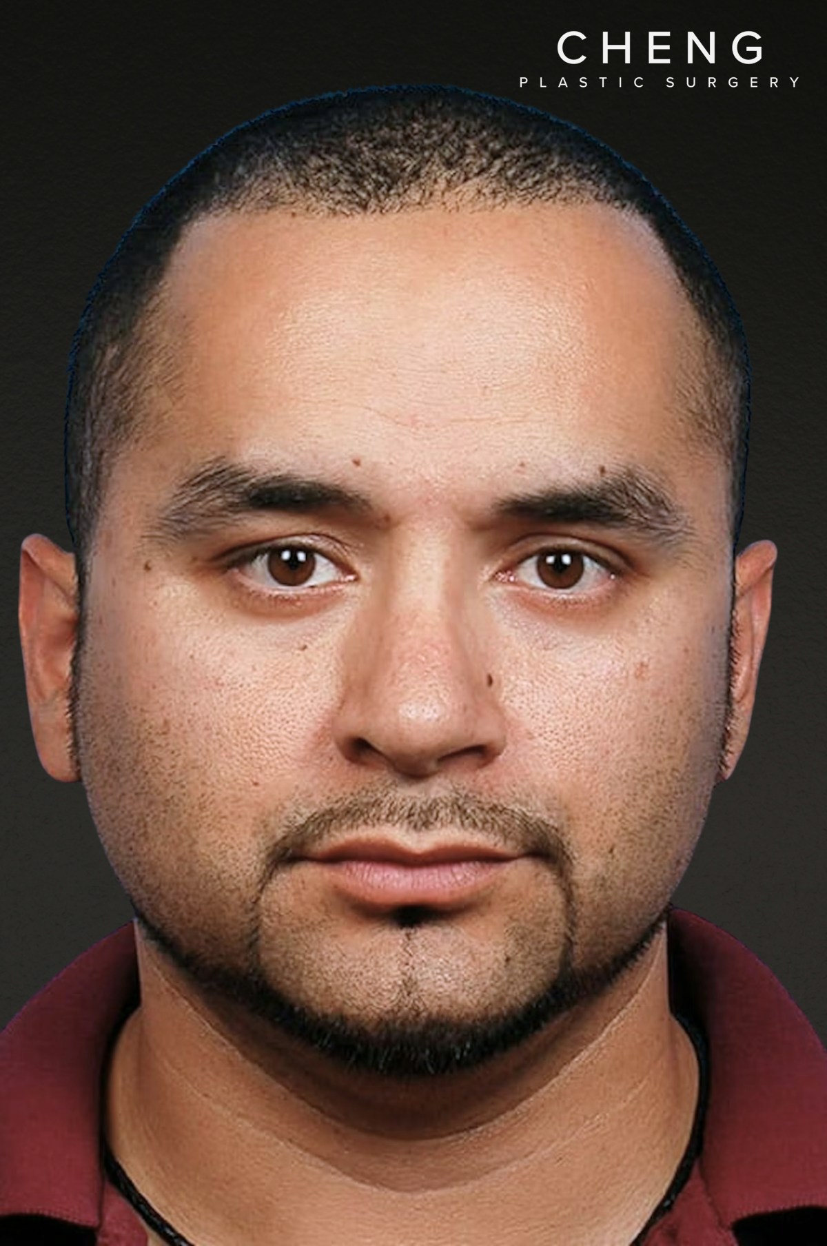 Rhinoplasty Before & After Gallery - Patient 237138 - Image 4