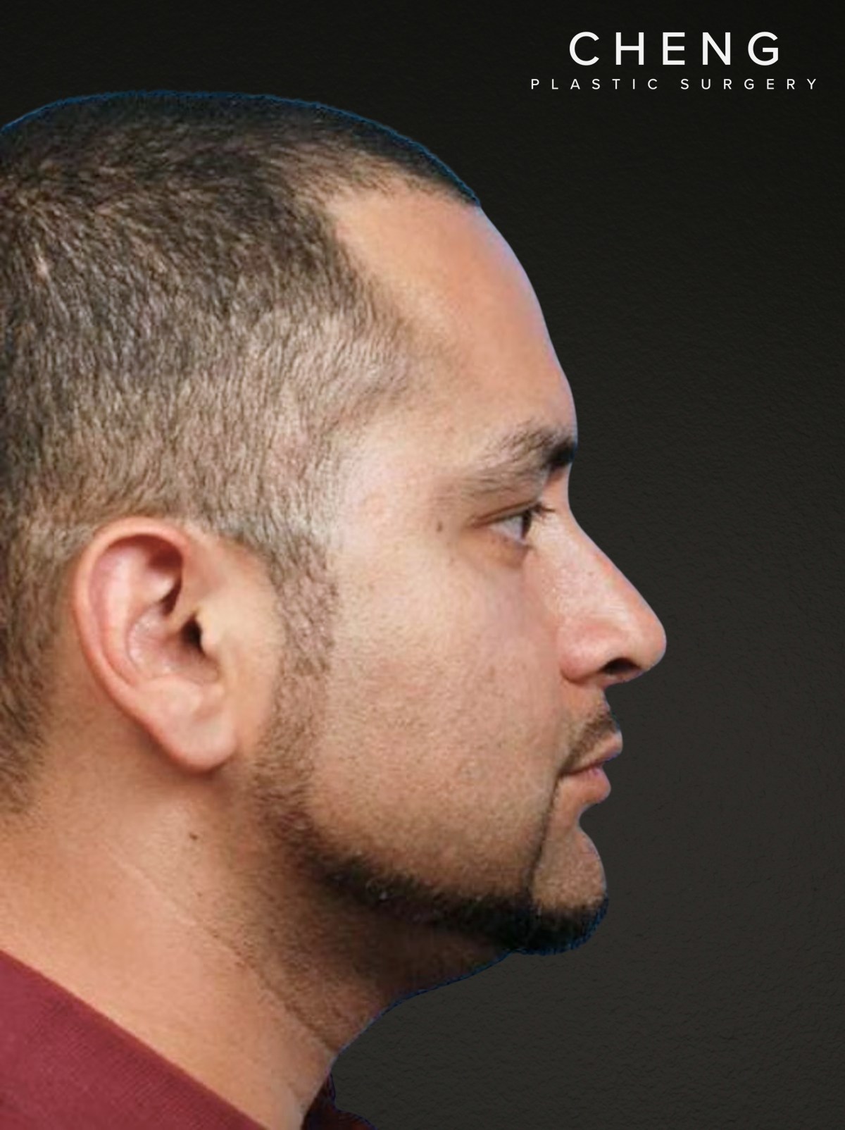 Rhinoplasty Before & After Gallery - Patient 237138 - Image 2