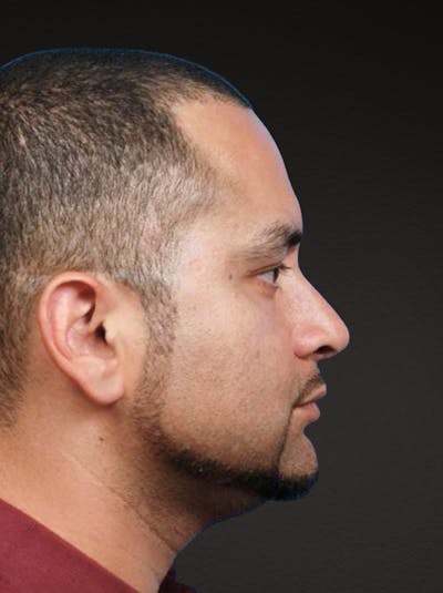 Rhinoplasty Before & After Gallery - Patient 237138 - Image 2