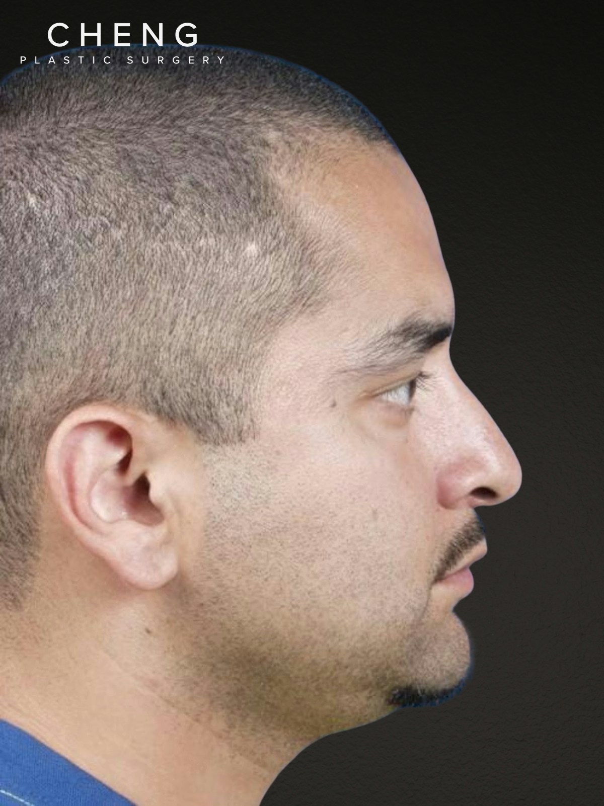 Rhinoplasty Before & After Gallery - Patient 237138 - Image 1