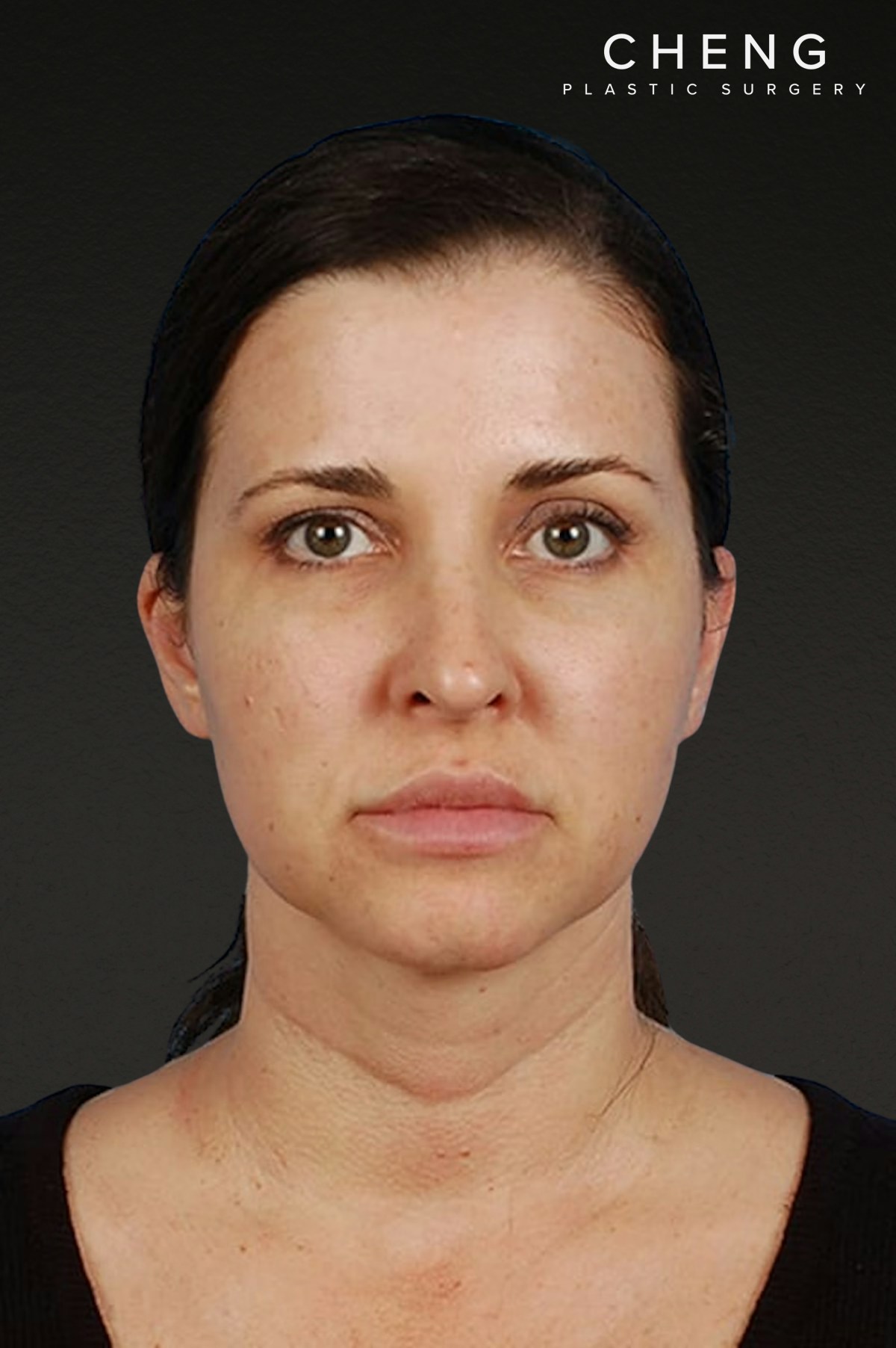Rhinoplasty Before & After Gallery - Patient 378514 - Image 4