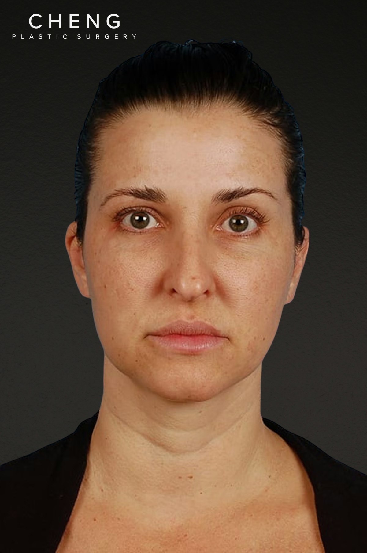 Rhinoplasty Before & After Gallery - Patient 378514 - Image 3