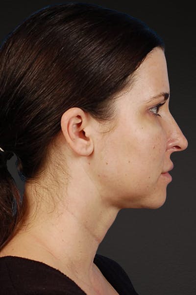 Rhinoplasty Before & After Gallery - Patient 378514 - Image 2