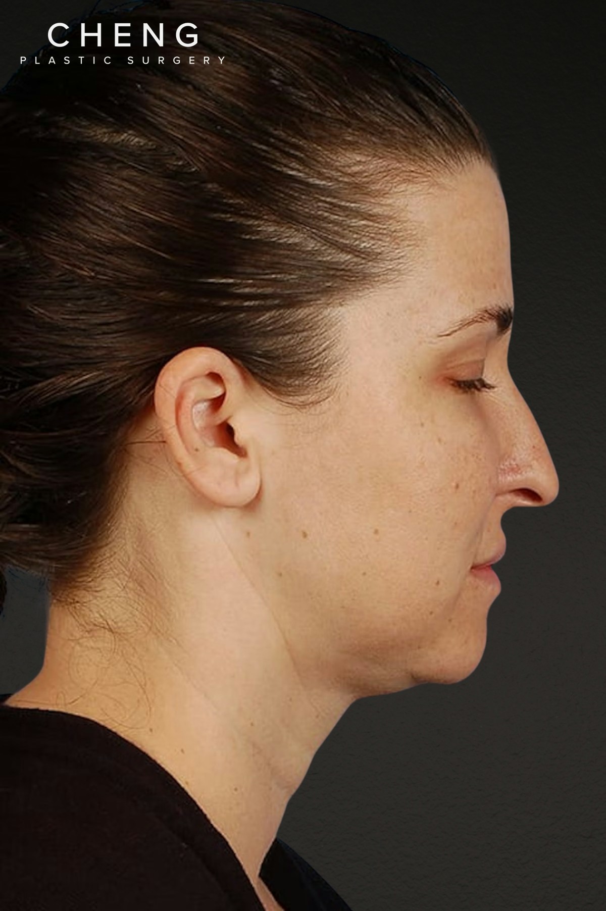 Rhinoplasty Before & After Gallery - Patient 378514 - Image 1