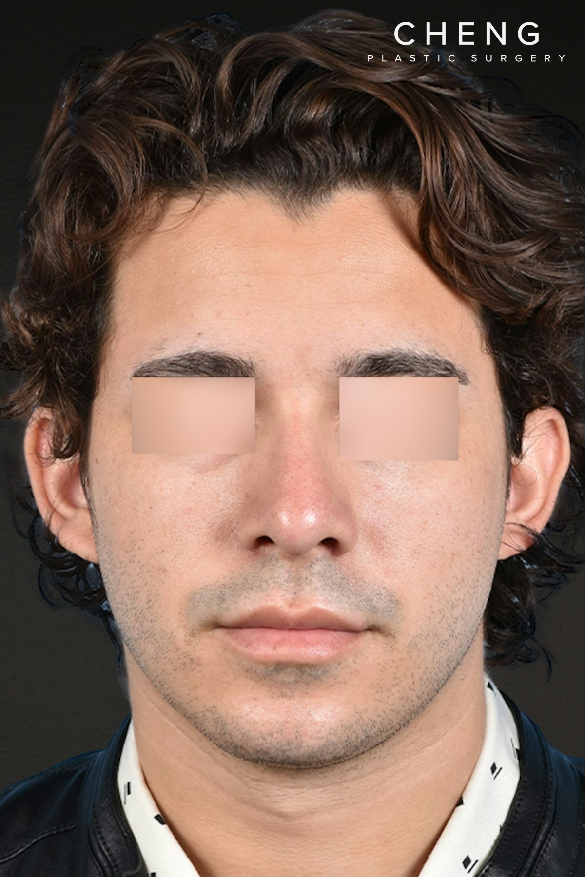 Rhinoplasty Before & After Gallery - Patient 323731 - Image 10