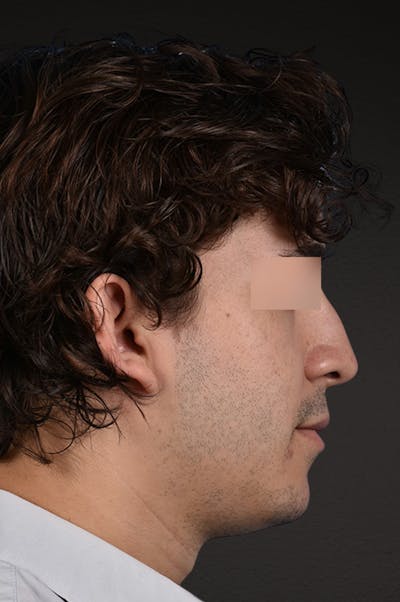 Rhinoplasty Before & After Gallery - Patient 323731 - Image 1