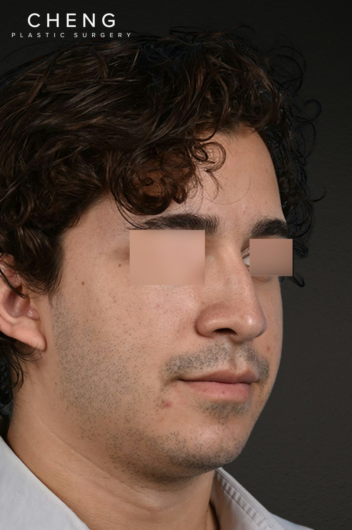 Rhinoplasty Before & After Gallery - Patient 323731 - Image 7