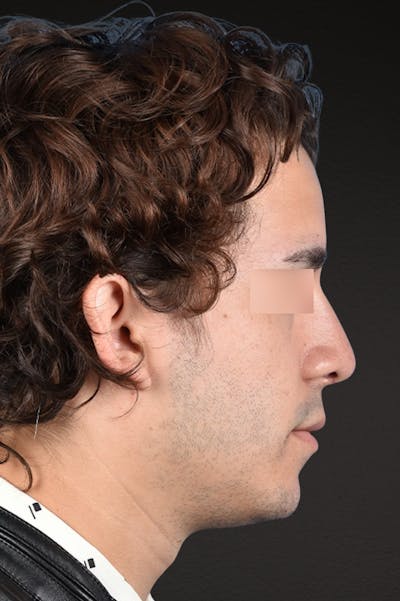 Rhinoplasty Before & After Gallery - Patient 323731 - Image 2