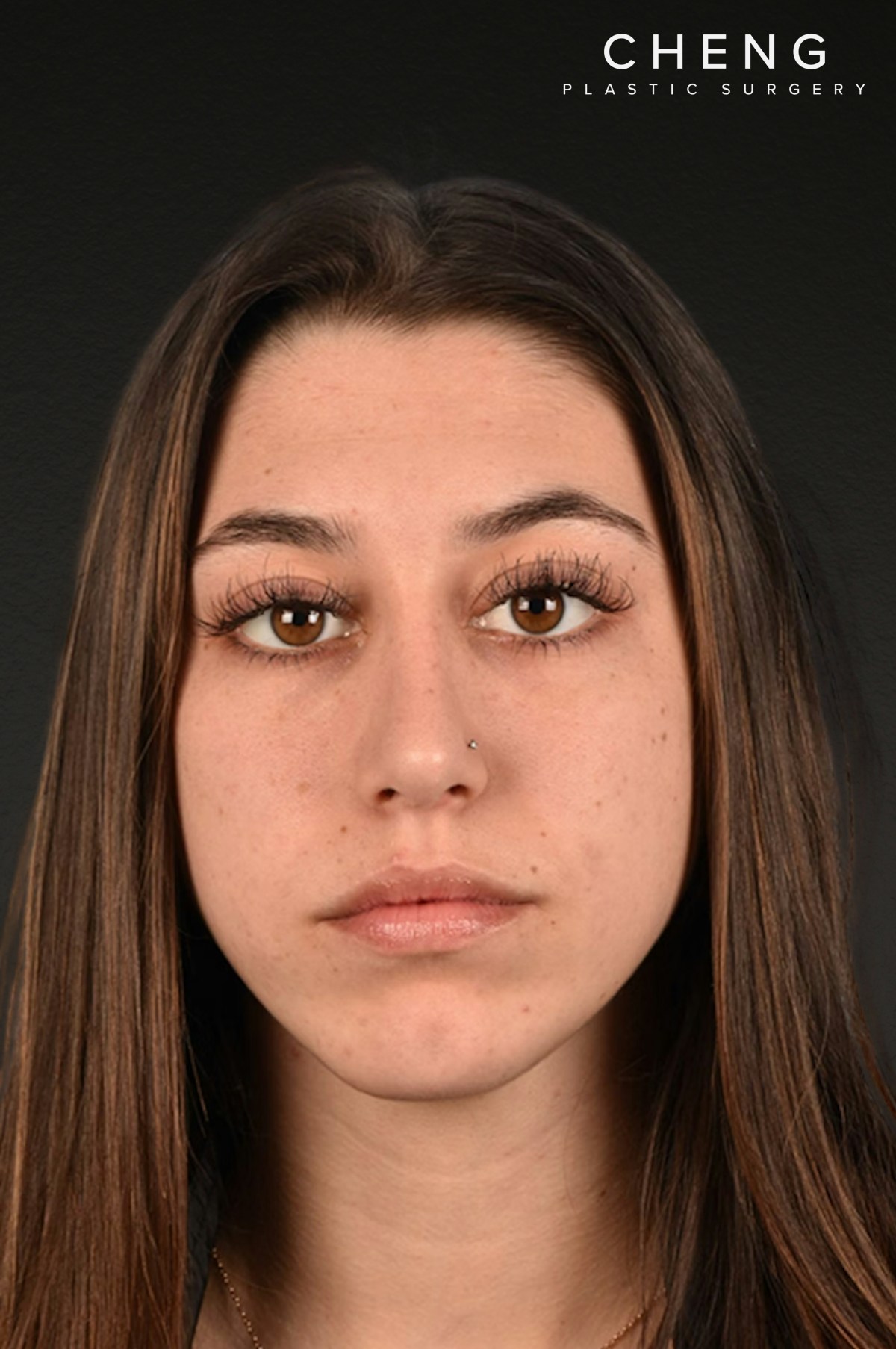 Rhinoplasty Before & After Gallery - Patient 304396 - Image 4