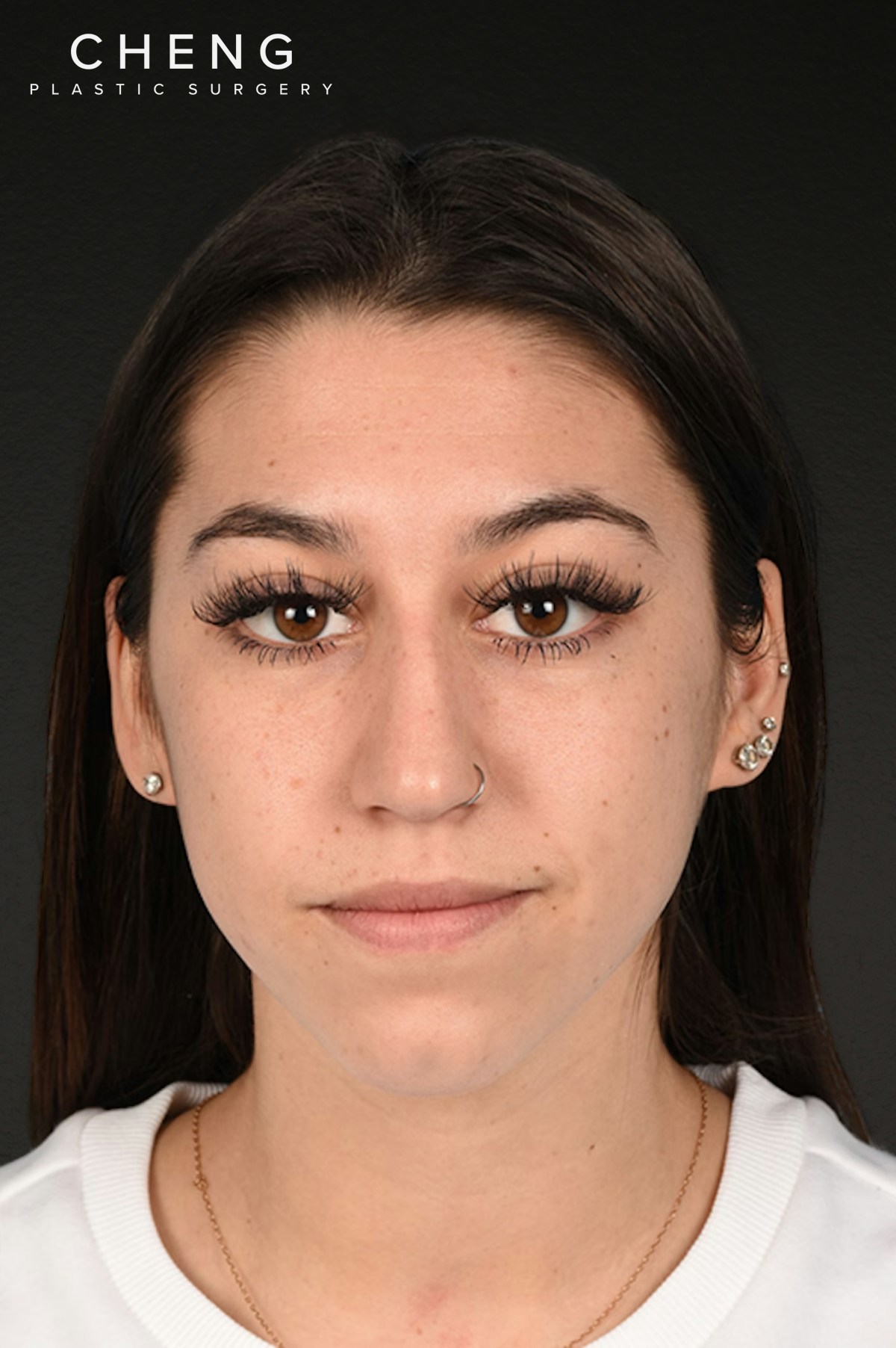 Rhinoplasty Before & After Gallery - Patient 304396 - Image 3