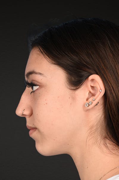 Rhinoplasty Before & After Gallery - Patient 304396 - Image 1