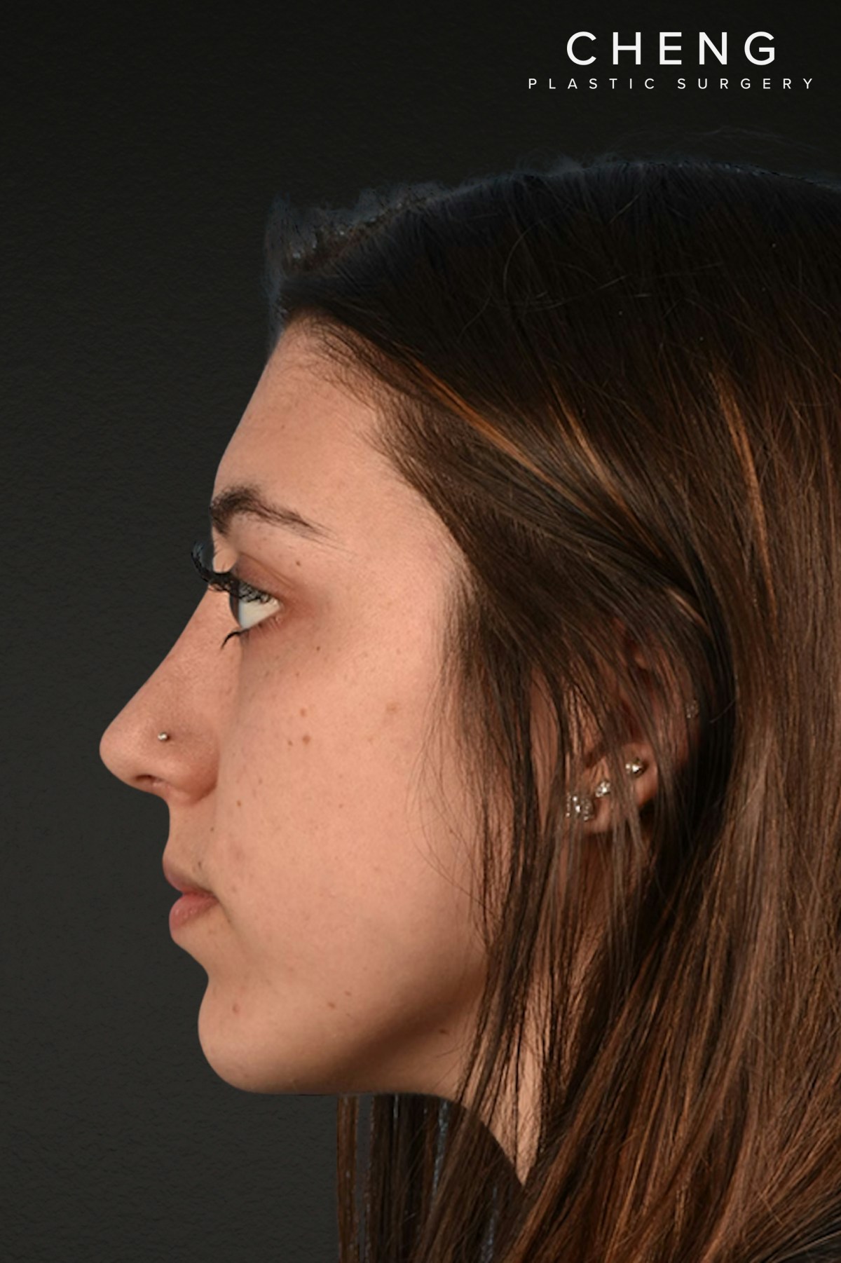 Rhinoplasty Before & After Gallery - Patient 304396 - Image 2