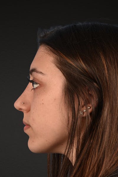 Rhinoplasty Before & After Gallery - Patient 304396 - Image 2