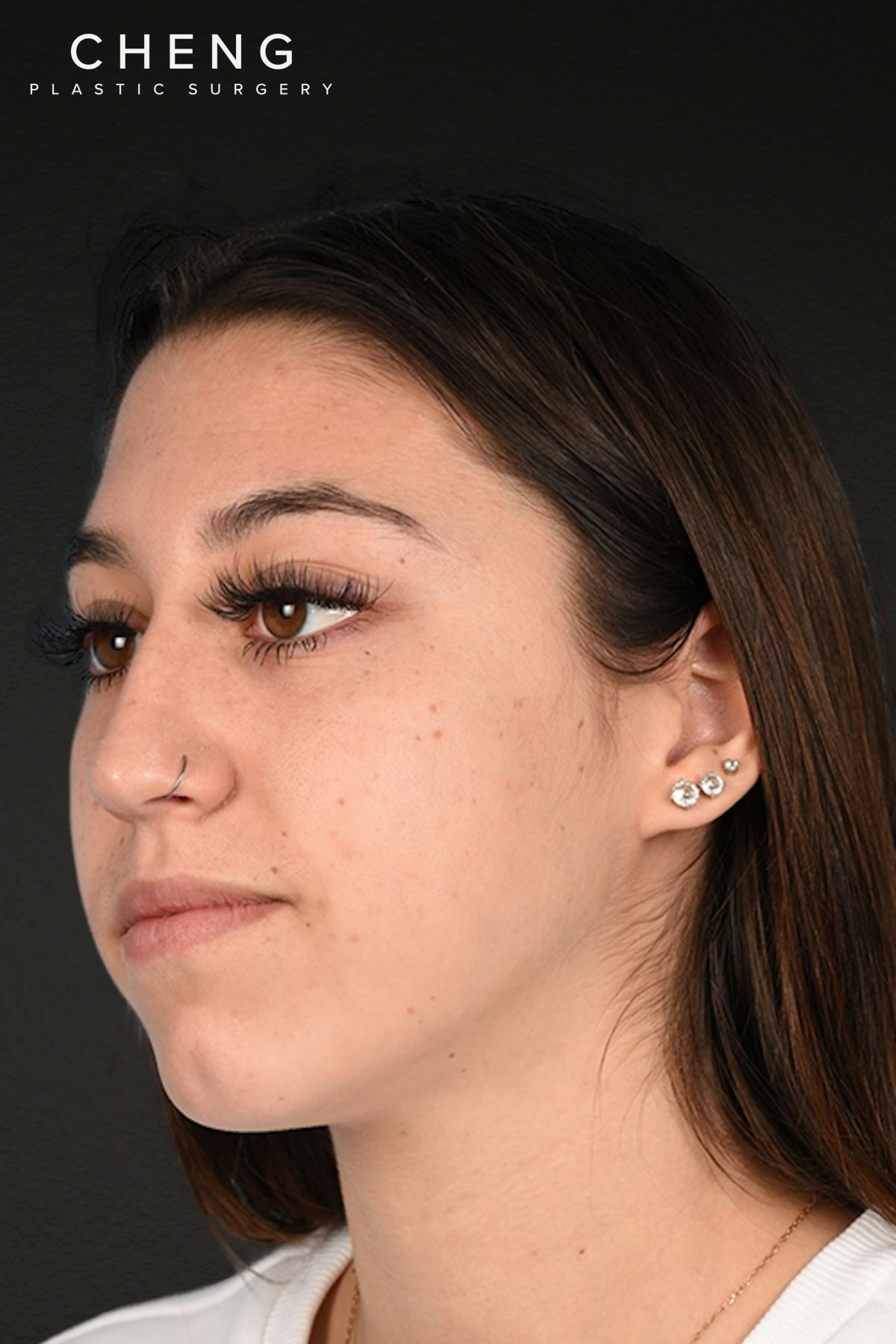 Rhinoplasty Before & After Gallery - Patient 304396 - Image 5