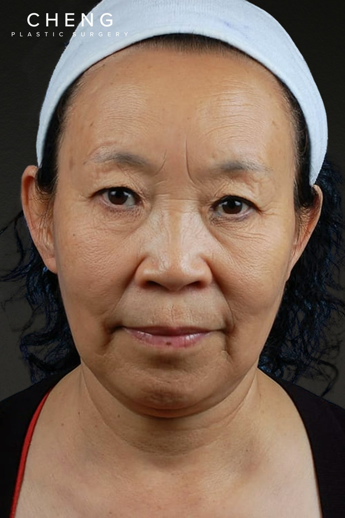 Rhinoplasty Before & After Gallery - Patient 115275 - Image 5