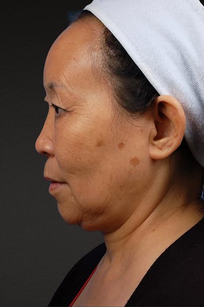 Rhinoplasty Before & After Gallery - Patient 115275 - Image 1