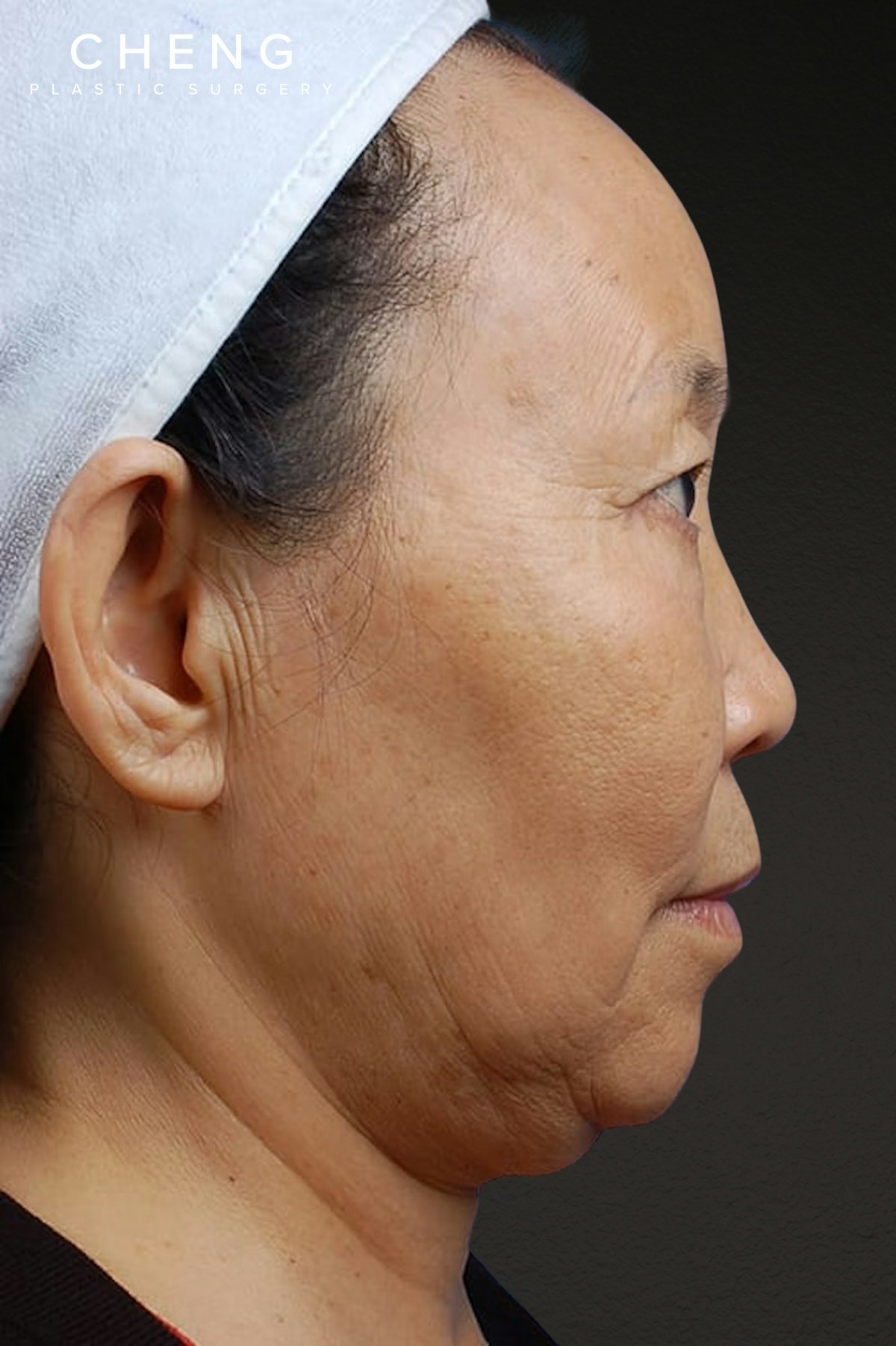 Rhinoplasty Before & After Gallery - Patient 115275 - Image 3