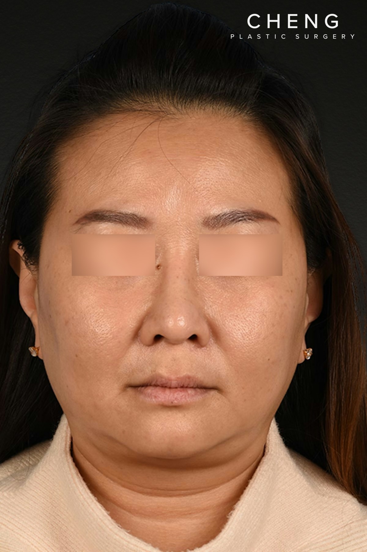 Rhinoplasty Before & After Gallery - Patient 403670 - Image 6