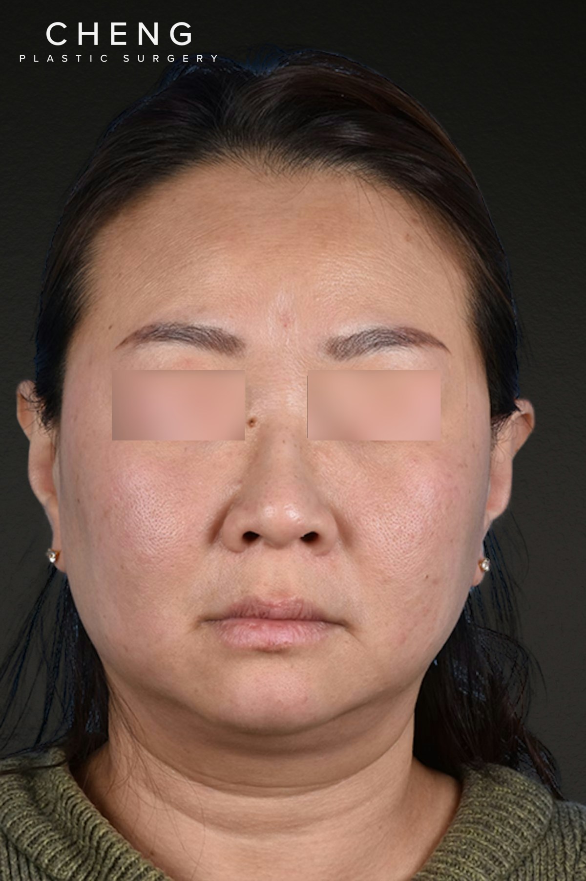 Rhinoplasty Before & After Gallery - Patient 403670 - Image 5