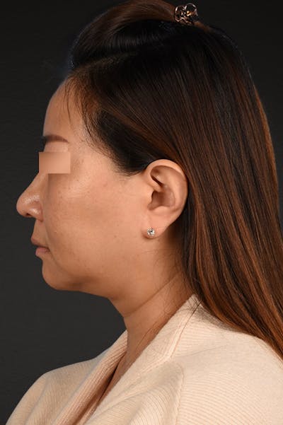 Rhinoplasty Before & After Gallery - Patient 403670 - Image 2