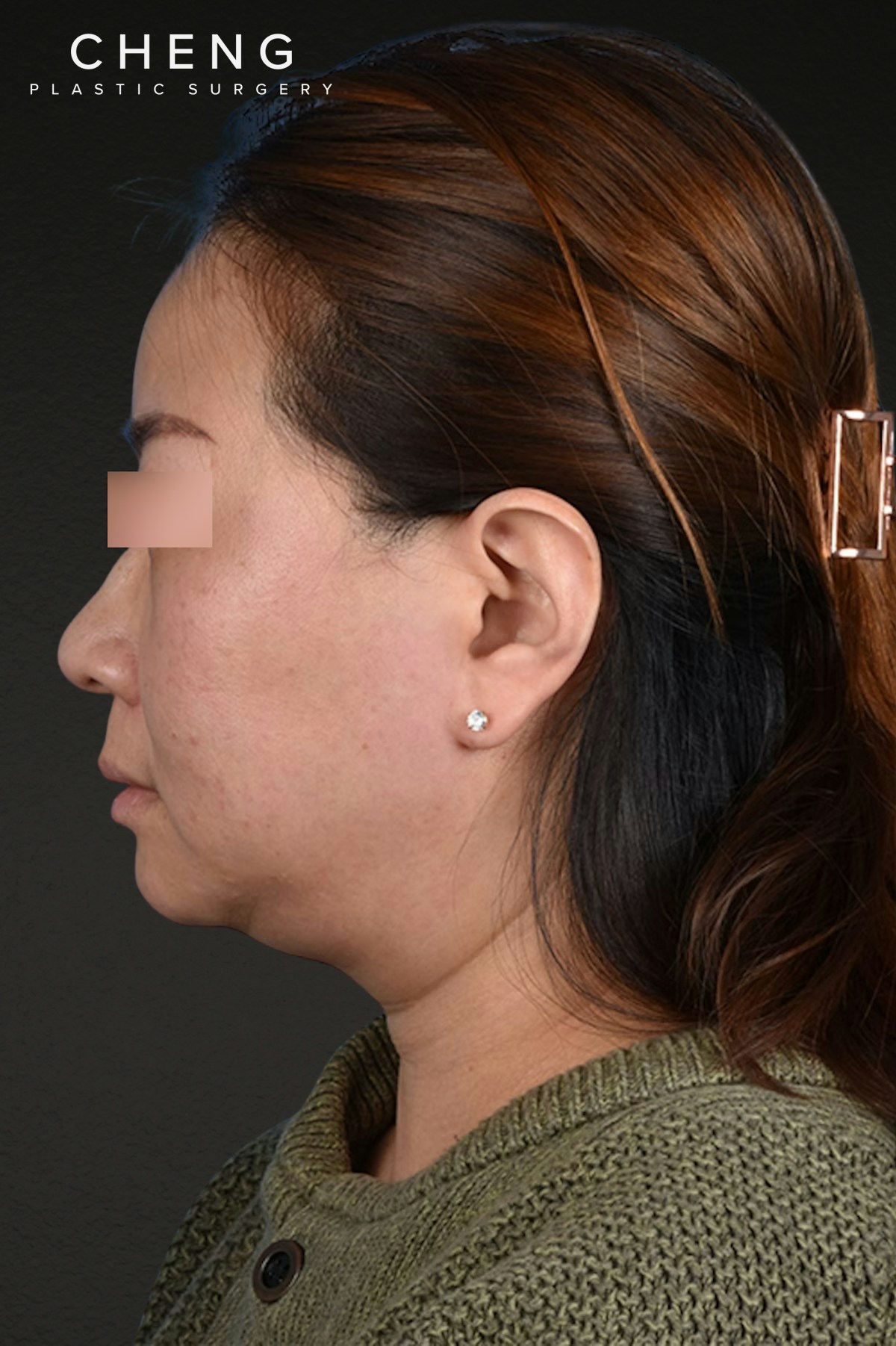 Rhinoplasty Before & After Gallery - Patient 403670 - Image 1