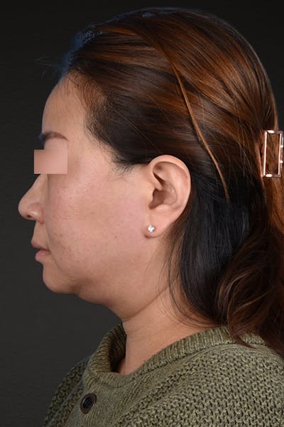 Rhinoplasty Before & After Gallery - Patient 403670 - Image 1