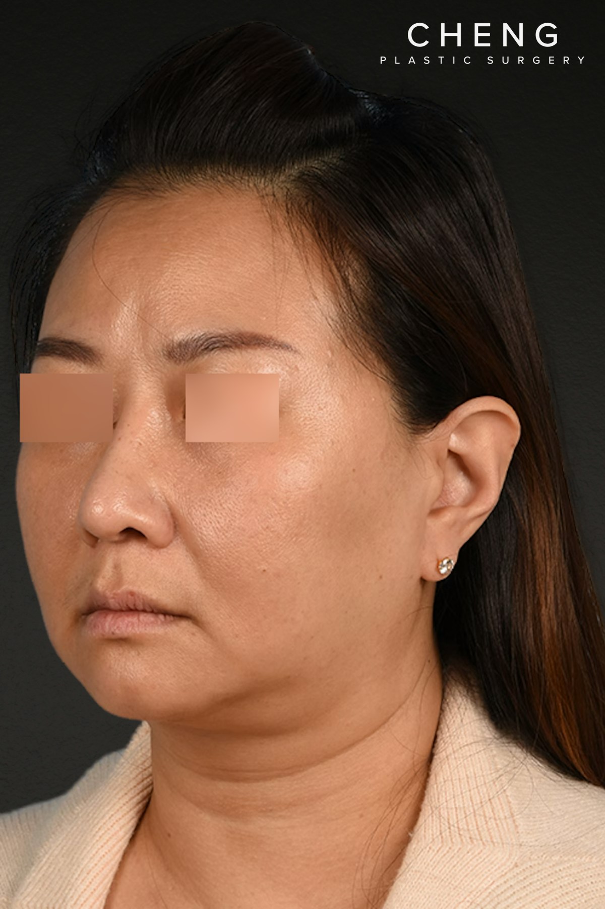 Rhinoplasty Before & After Gallery - Patient 403670 - Image 4