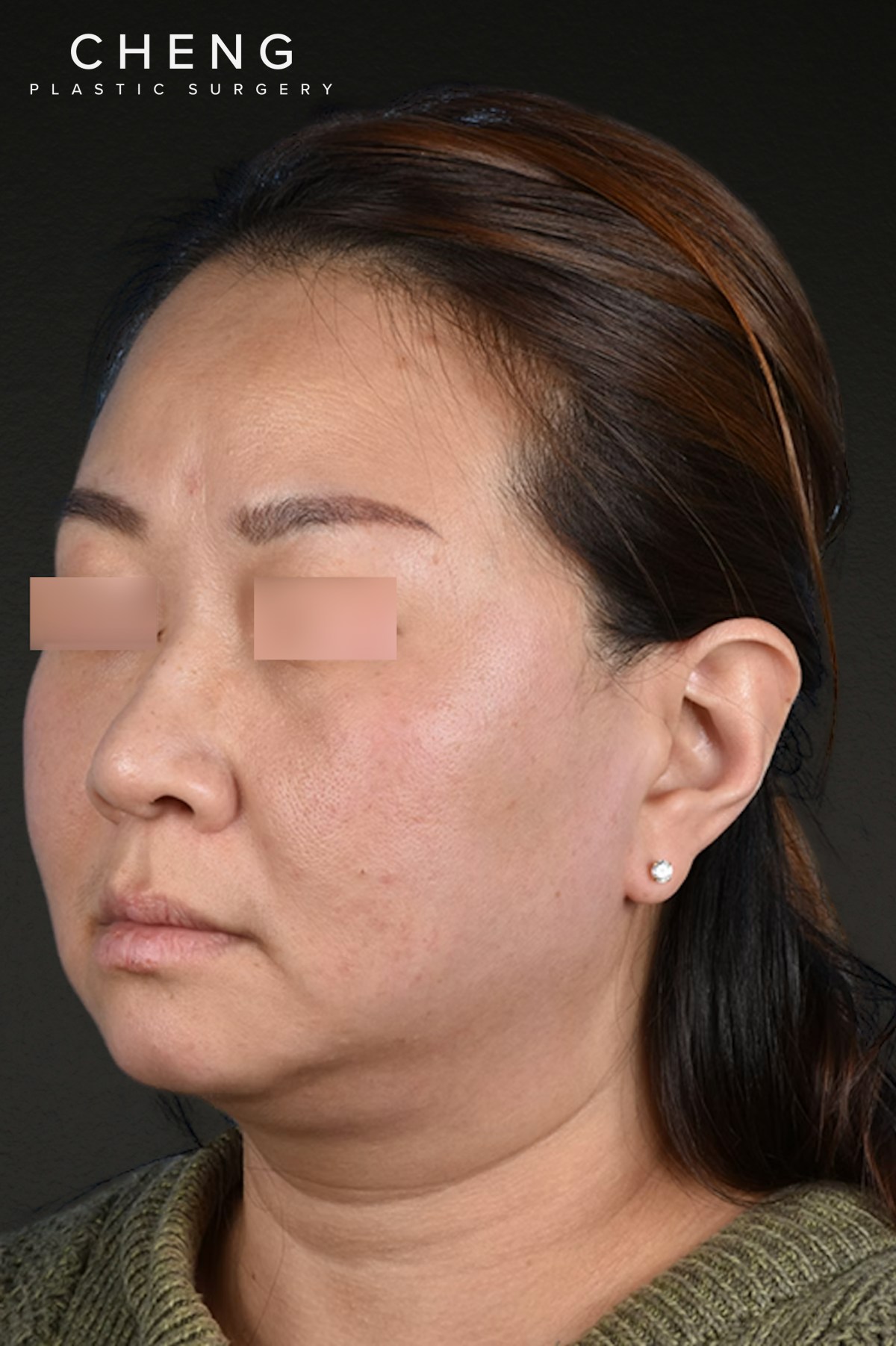 Rhinoplasty Before & After Gallery - Patient 403670 - Image 3