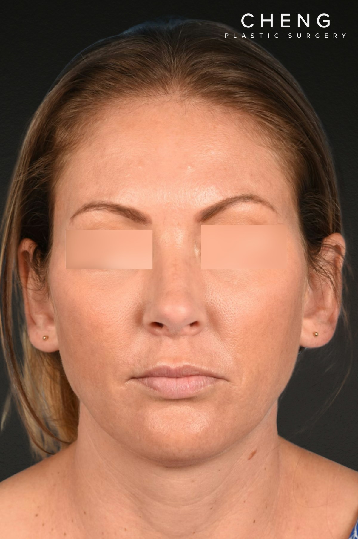 Rhinoplasty Before & After Gallery - Patient 117002 - Image 4