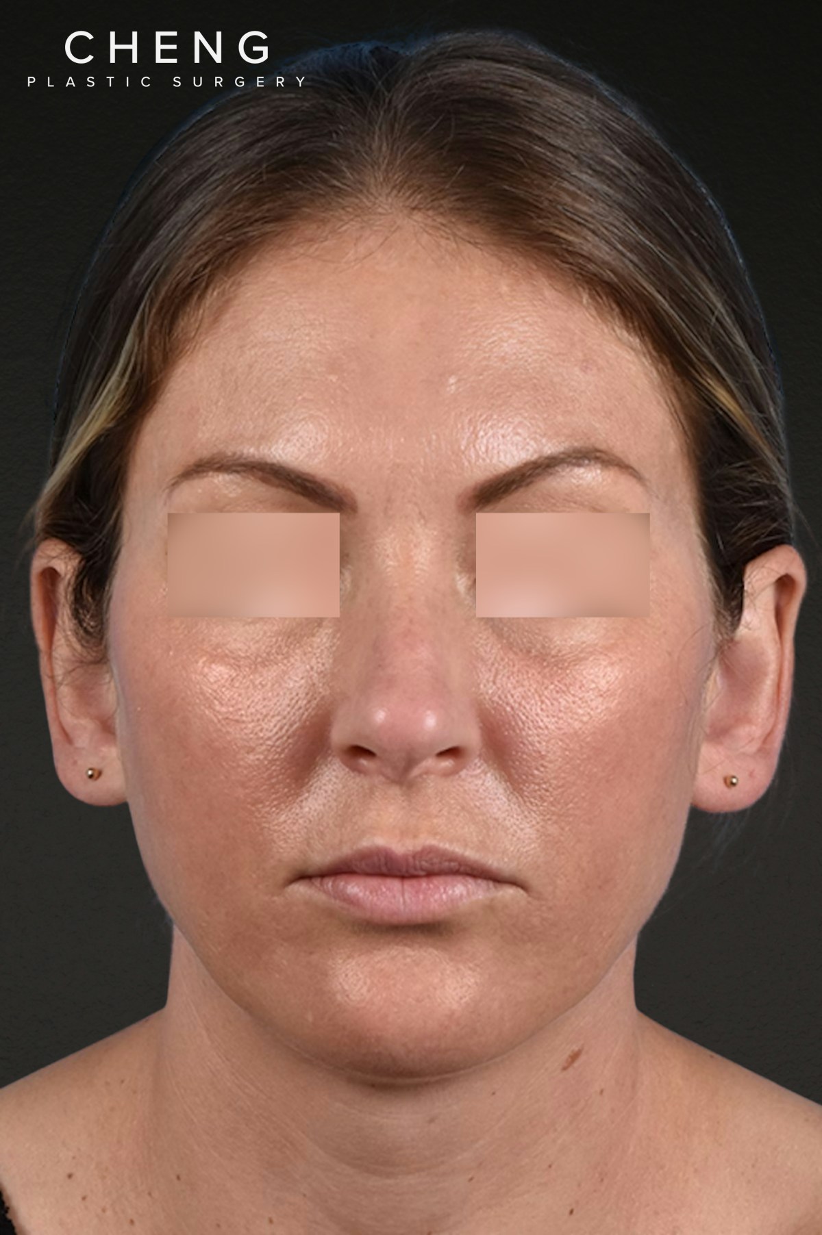 Rhinoplasty Before & After Gallery - Patient 117002 - Image 3